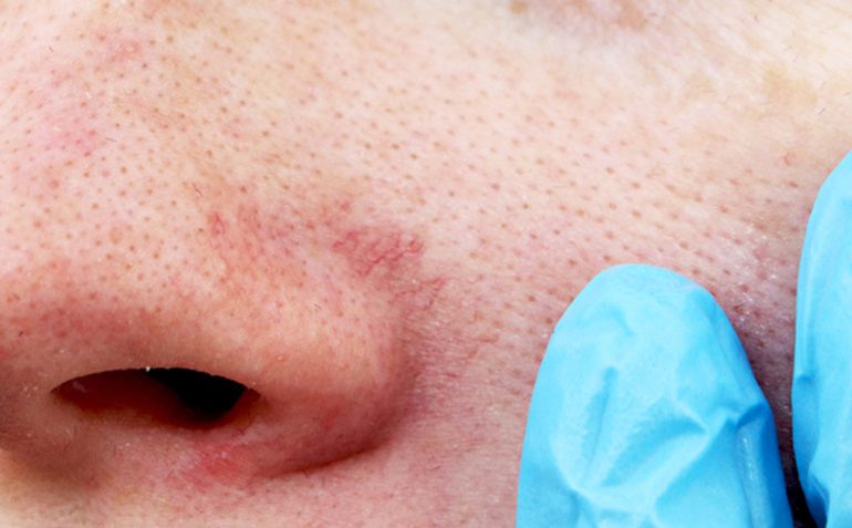 Die Nase einer Frau, die eine Couperose-Behandlung erhält, mit einem blauen Handschuh darauf.