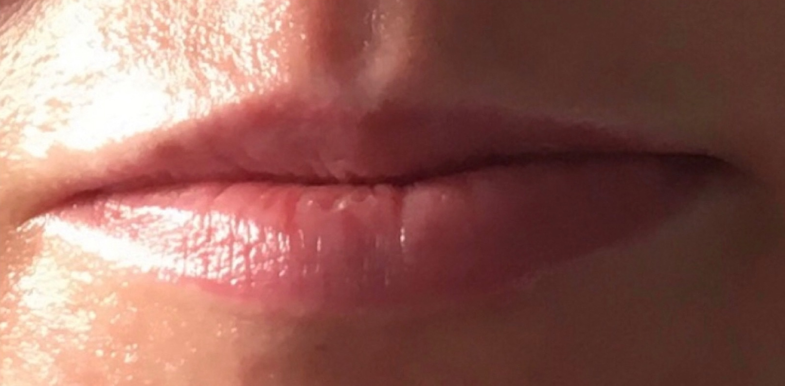Lippen Vorher und Nachher