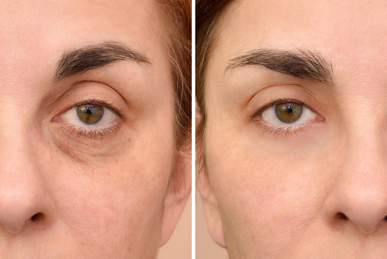 Vorher-Nachher-Fotos von einer Augenfalten-Behandlung einer Frau.