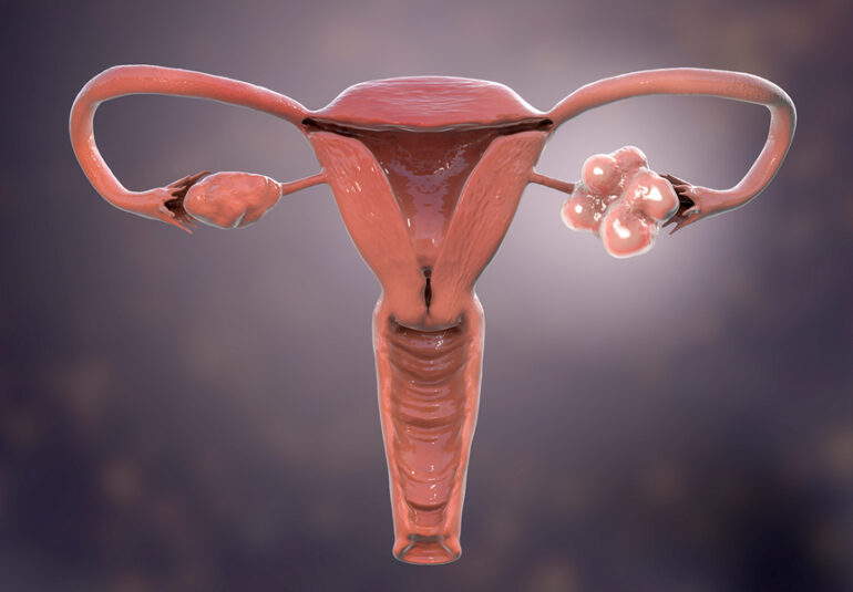 Polyzystisches Ovar-Syndrom, 3D-Illustration mit gesundem Ovar (rechts) und vergrößertem Ovar mit Zysten (links))