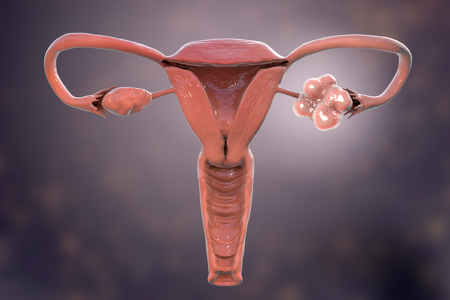 Polyzystisches Ovar-Syndrom, 3D-Illustration mit gesundem Ovar (rechts) und vergrößertem Ovar mit Zysten (links))